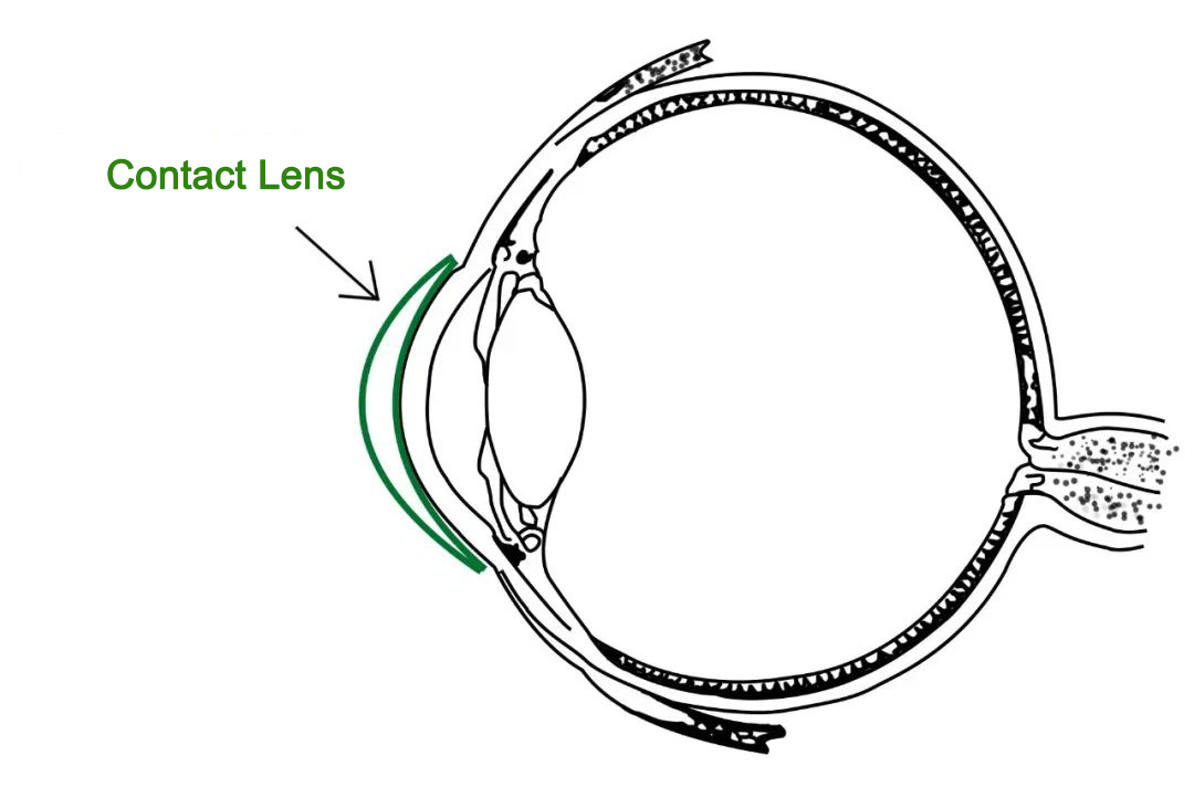 contact lenses in the eye