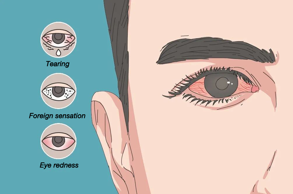 eye discomfort symptoms